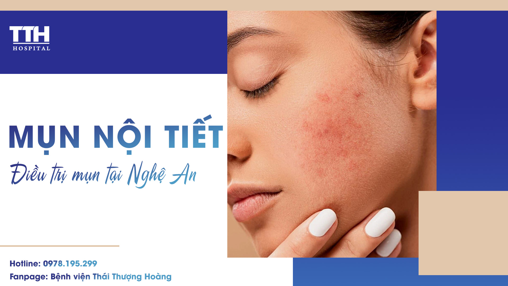 Mụn nội tiết và điều trị mụn tại Nghệ An